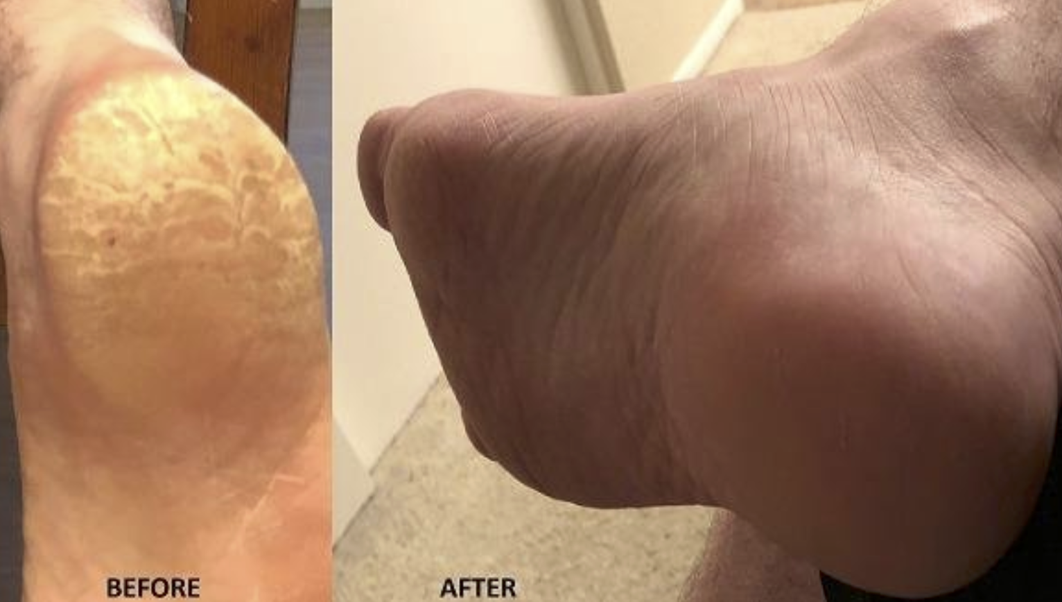 the left said shows a foot with cracks and calluses all over it and the right side shows the same reviewer&#x27;s foot looking completely smooth