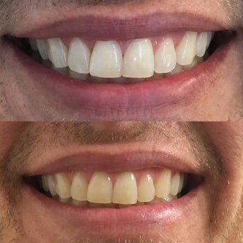 Reviewer before and after showing the strips significantly whitened their yellow teeth