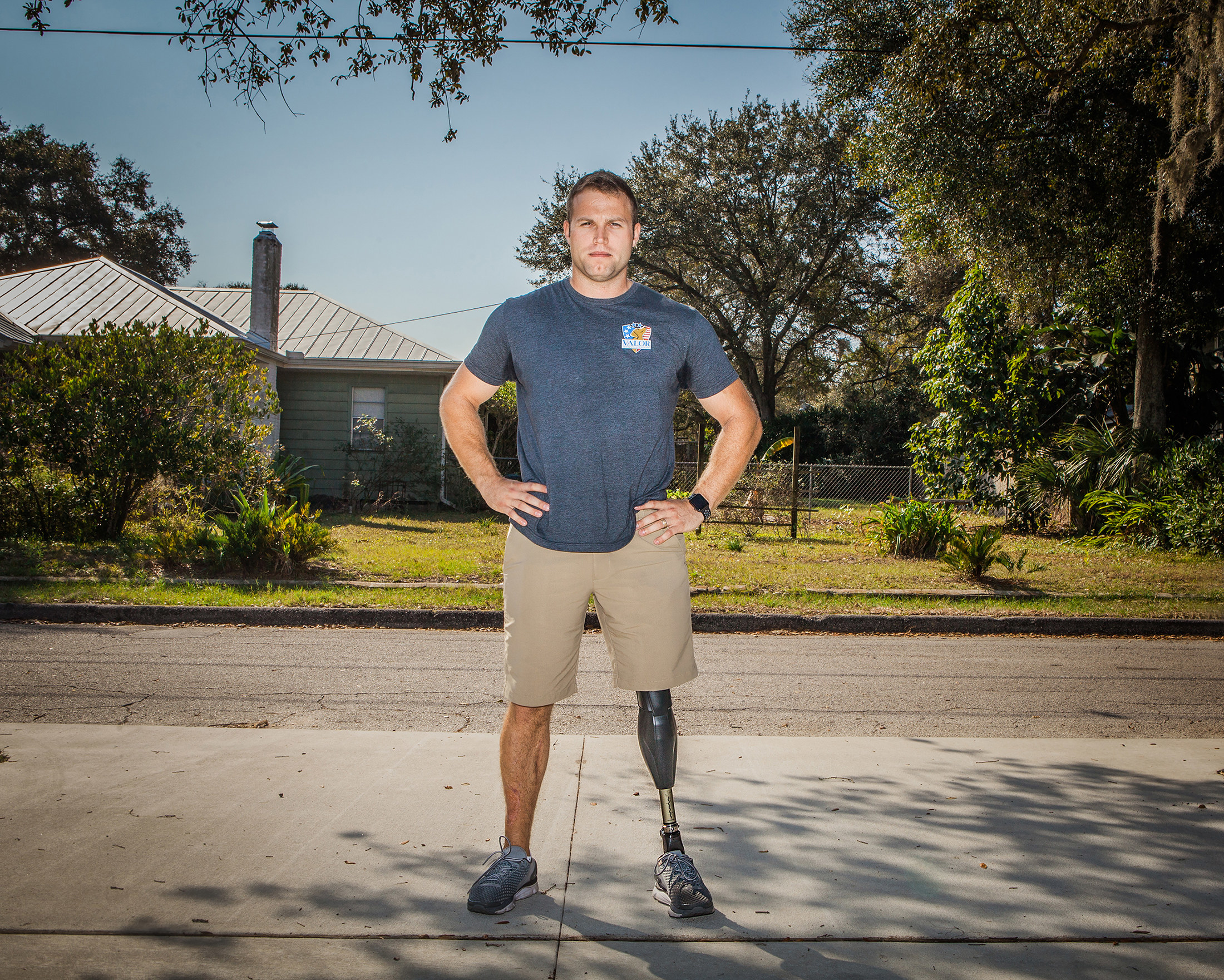 A young guy standing with a prosthetic leg