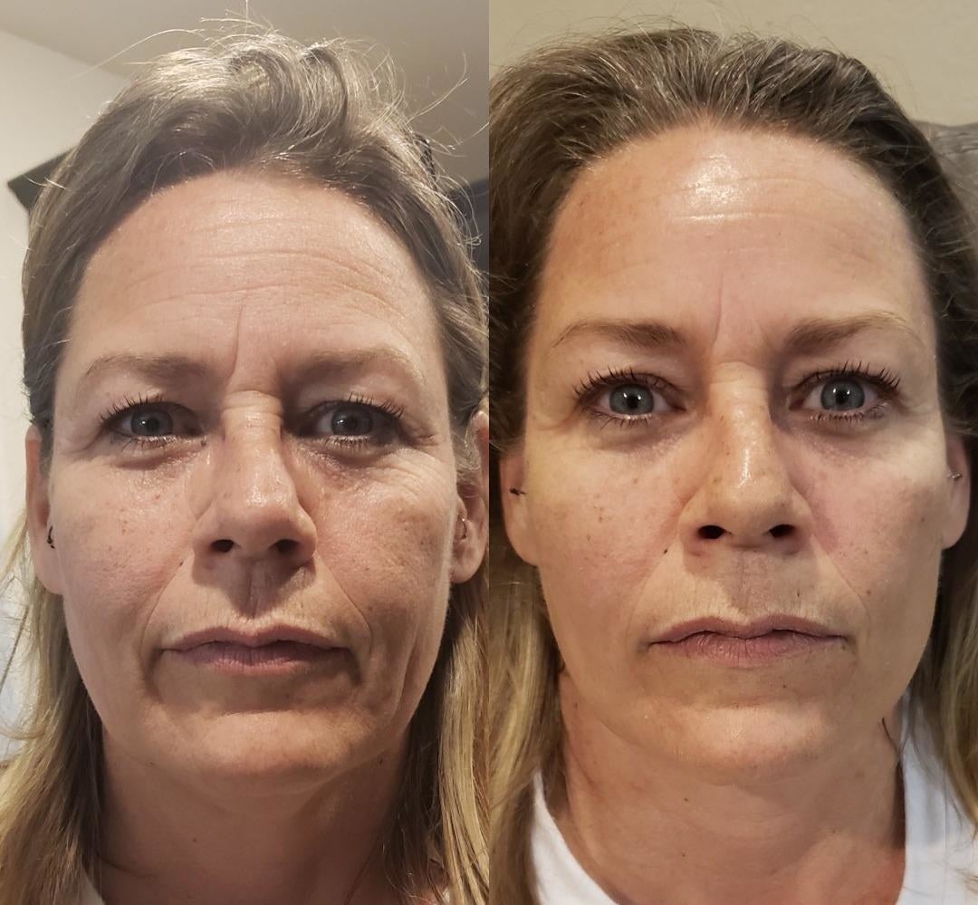 Reviewer's before and after and you can see that the mask has tightened their skin and reduced the appearance of lines on the forehead, around the eyes, and around the mouth