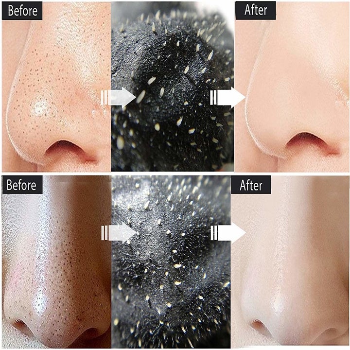 Before and after images of a nose with the use of the peel-off mask.