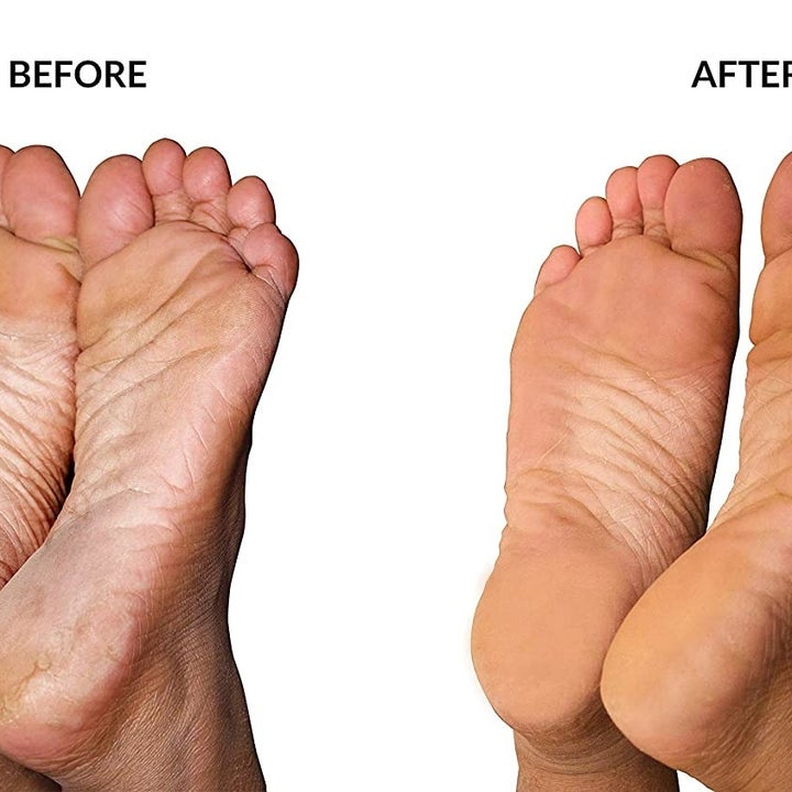 Before and after shots upon use of the foot mask.