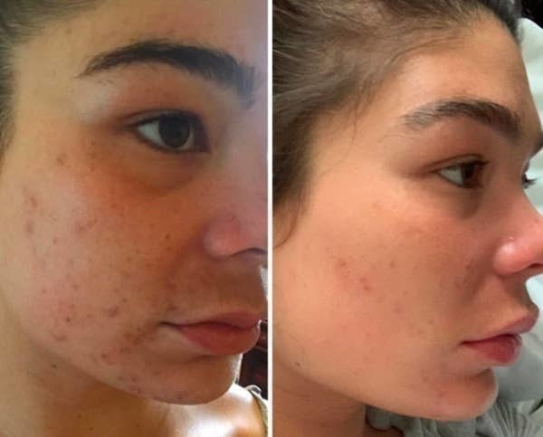 On the left, a before photo of a reviewer with acne on their face, and on the right, the same reviewer, but with most of their acne cleared up