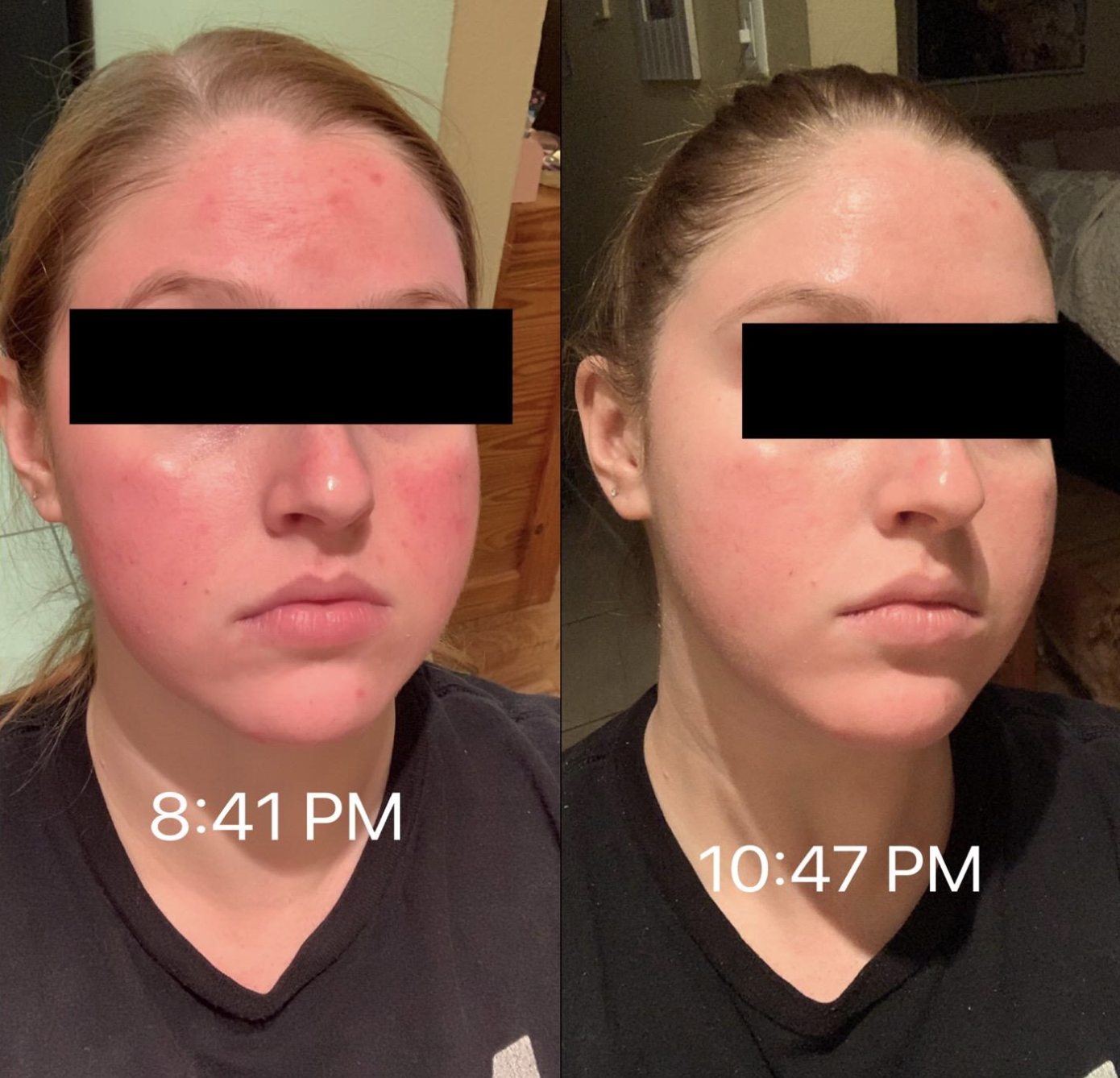 before and after photo of reviewer on left with visibly red skin labeled &quot;8:41pm&quot; and on right, visibly less red skin labeled &quot;10:47pm&quot; 
