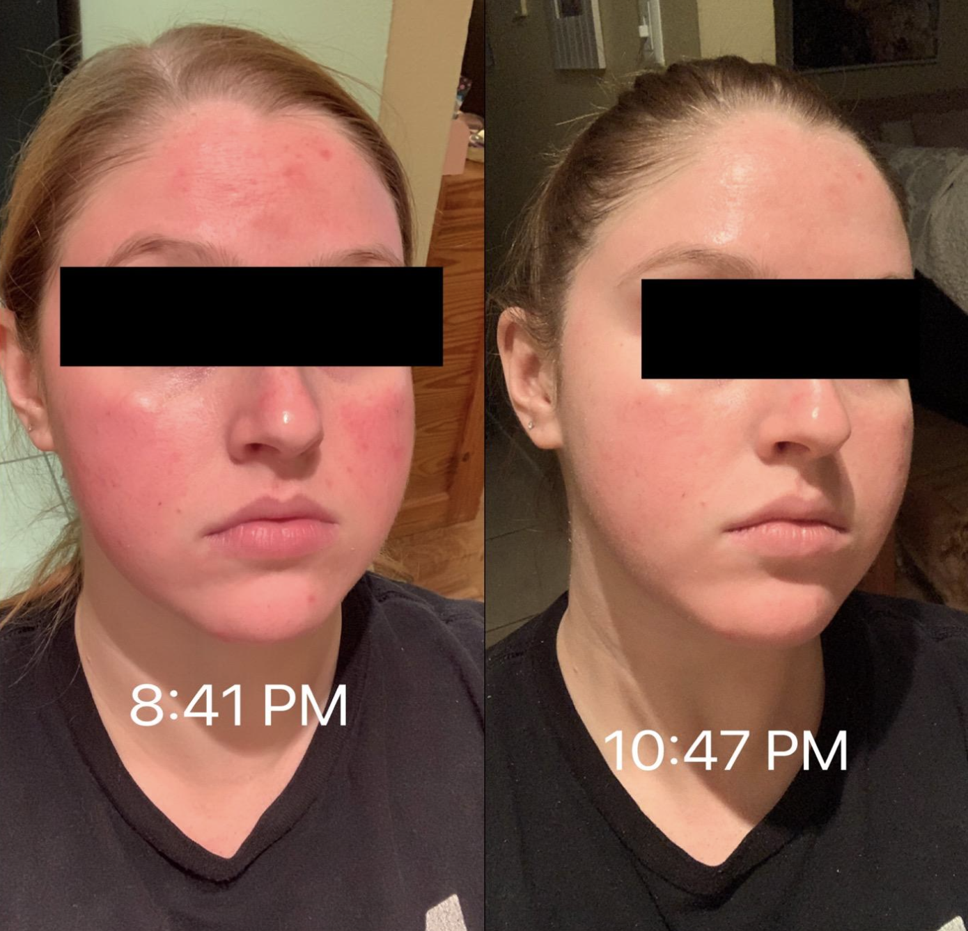 before and after photo of reviewer on left with visibly red skin labeled "8:41pm" and on right, visibly less red skin labeled "10:47pm" 