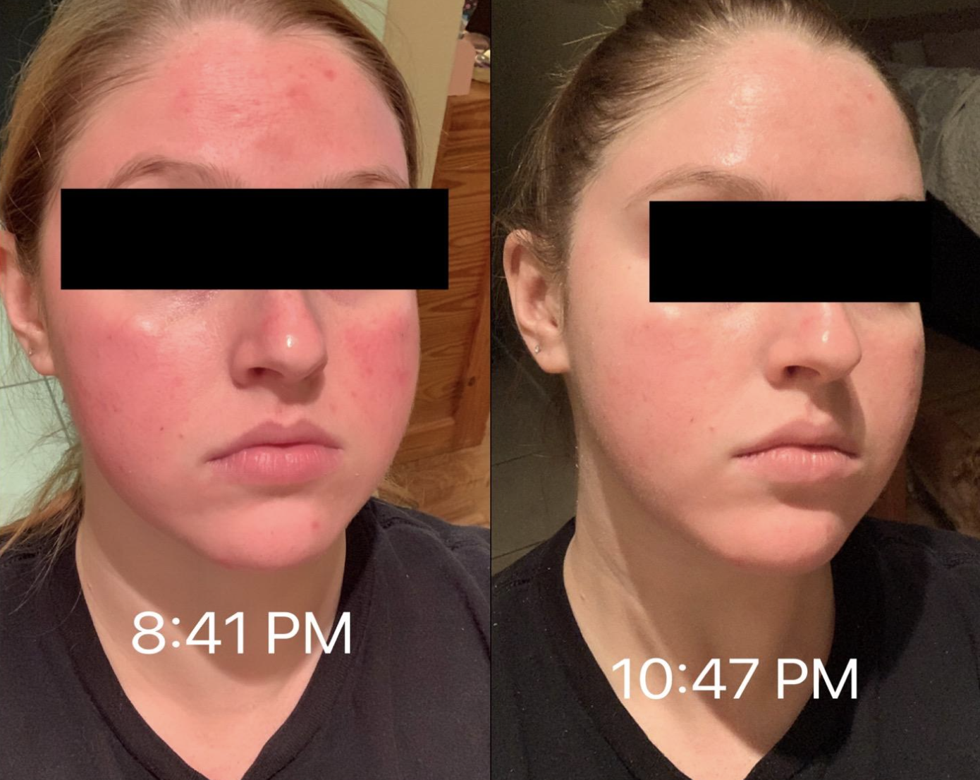 before and after photo of reviewer on left with visibly red skin labeled &quot;8:41pm&quot; and on right, visibly less red skin labeled &quot;10:47pm&quot; 