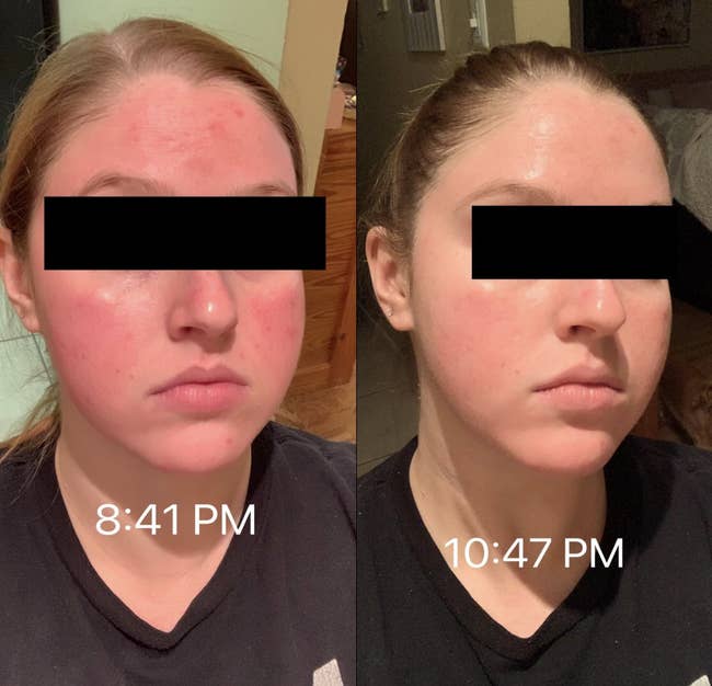 before and after photo of reviewer on left with visibly red skin labeled 