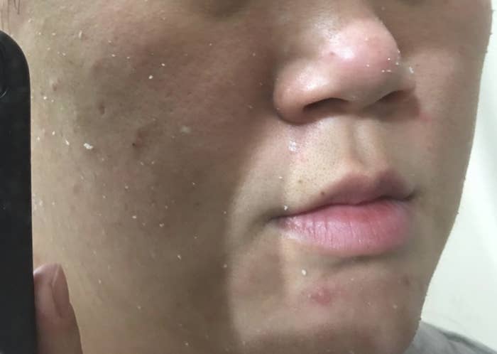 Amazon reviewer shows exfoliated skin after using water skin exfoliator