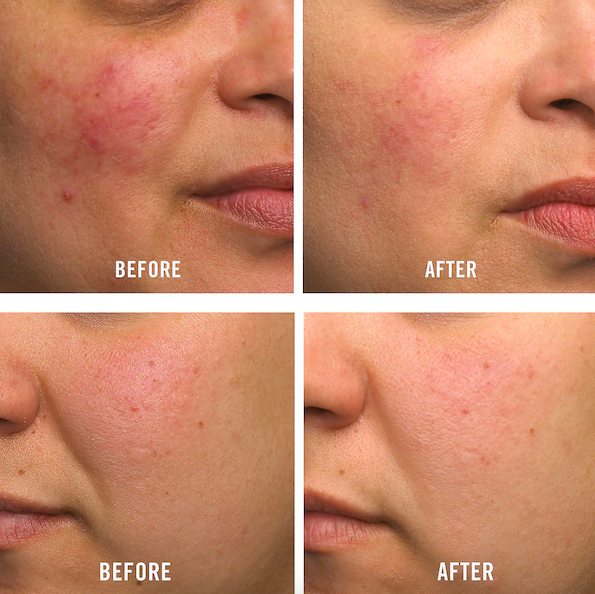 Two before and after results where one person had acne spots and redness that was reduced with product and another person had dry, red irritation that eased up after use. Both on cheeks. 