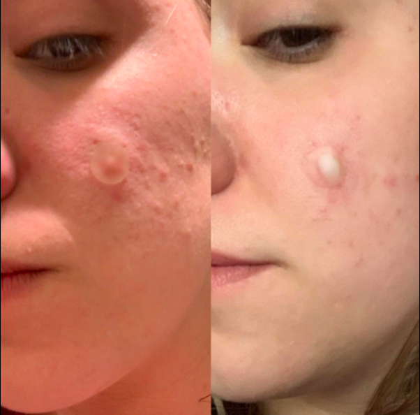 A customer&#x27;s before and after shots side by side; on the left a patch covers a pimple and on the right the same pimple has opened into the patch