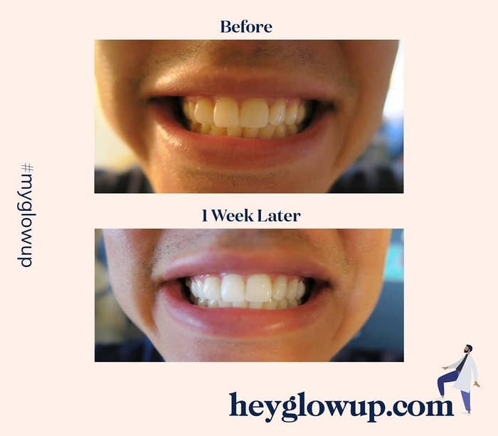 Before and after showing the whitening kit significantly whitened a user's teeth