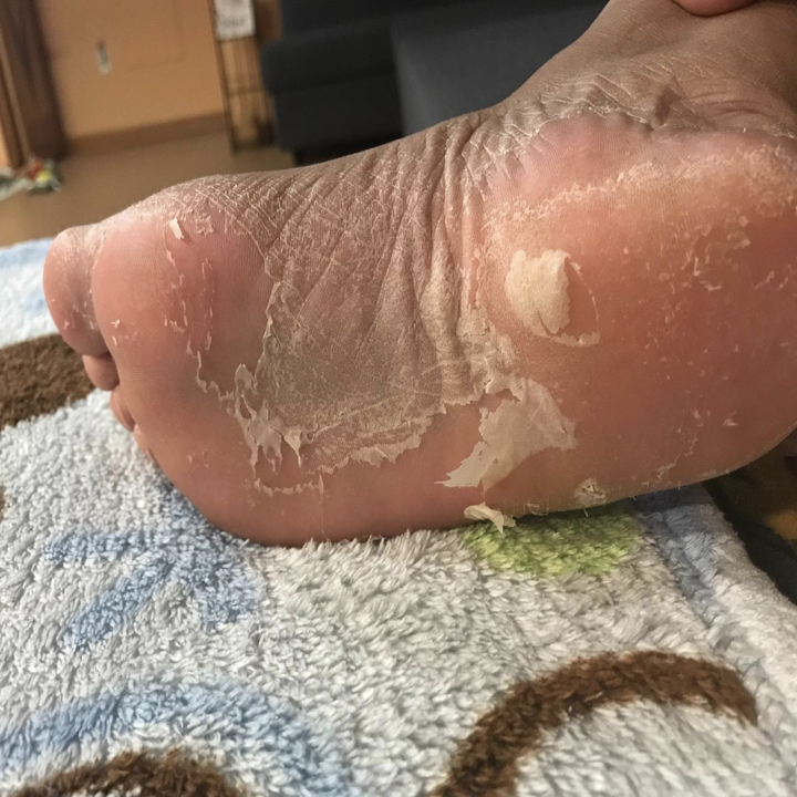 Reviewer image of skin peeling away on foot 