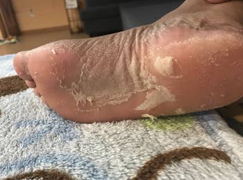 Reviewer's skin peeling away on foot 