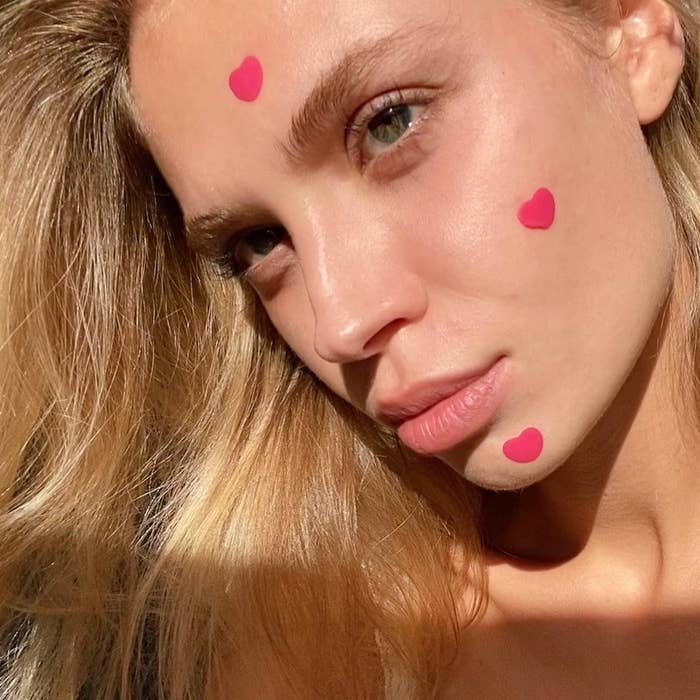 A person with heart-shaped acne patches on their face