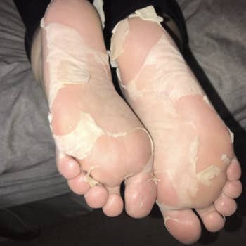 Reviewer peeling feet after using peel mask