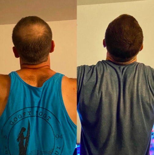 a before image of a reviewer with a bald spot on the top of their head next to an after image of that same bald spot filled in by the product