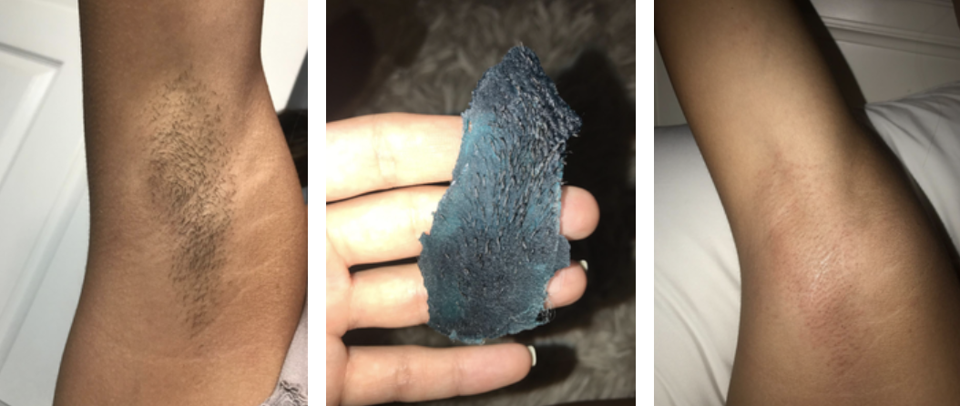 Reviewer before and after photo of blue wax results on underarms