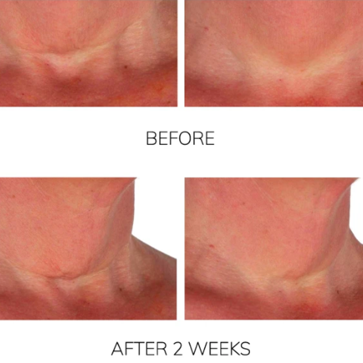 Two before and after photos with loose neck skin visibly tightened and wrinkles reduced after two weeks of use