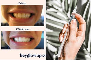 split thumbnail of before after of whitening, hand holding the whitening treatment gel