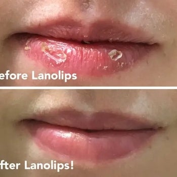 Reviewer photo of before and after lips using Lanolips