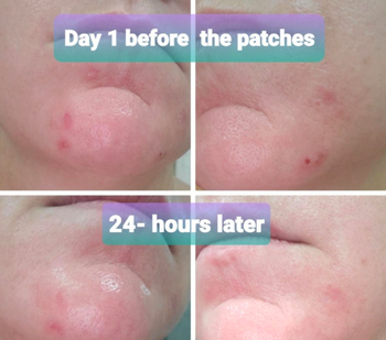 On the top, a reviewer's face with some small pimples on it, and on the bottom, the same reviewer's face a day later, with most of it cleared up