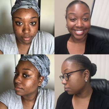 A reviewer with dark skin showing before and afters of how the serum lightened the acne scars on their forehead and cheeks 