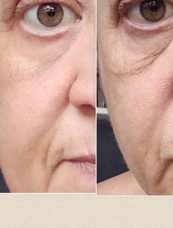 A customer review before and after  photo showing the cream tightened and brightened their under-eye area