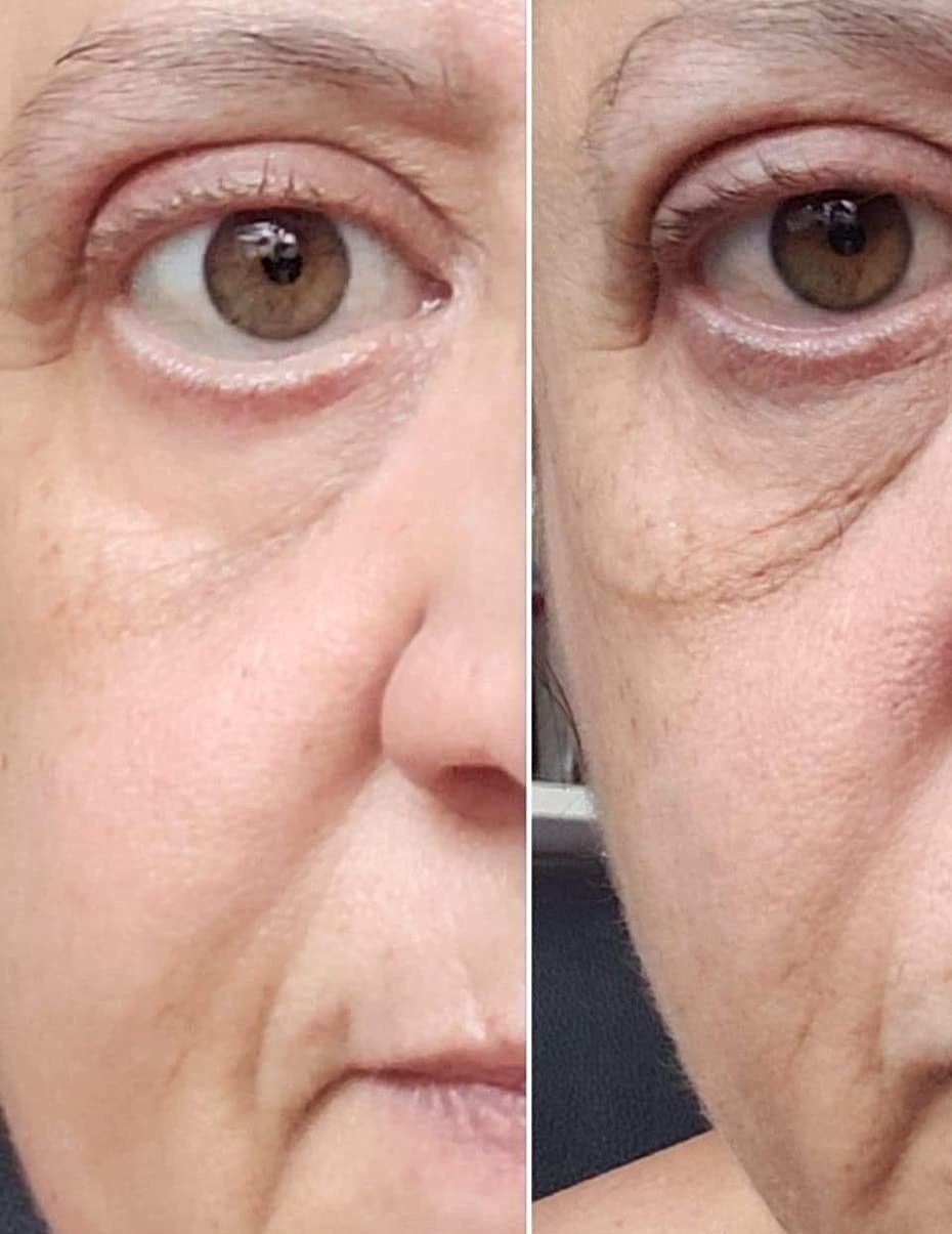 Reviewer before and after showing the cream tightened and brightened their under-eye area
