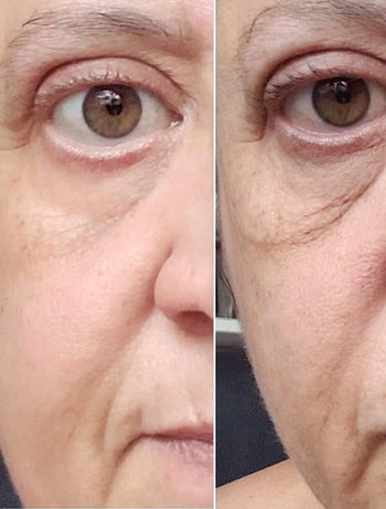 Reviewer before and after showing the cream tightened and brightened their under-eye area