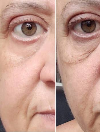 A customer review before and after  photo showing the cream tightened and brightened their under-eye area