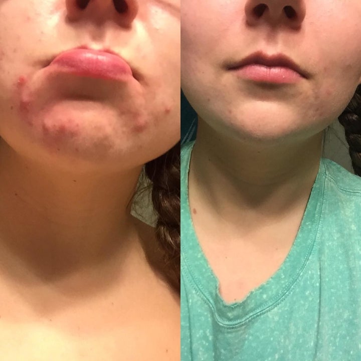 A reviewer's before and after photos which show them first with lots of acne and then with very minimal acne