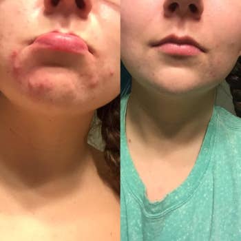 A reviewer's before and after photos which show them first with lots of acne and then with very minimal acne