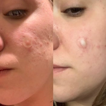 A reviewer's before and after photo which shows how the patch has drawn pus out of a pimple