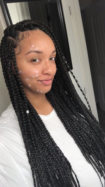 A reviewer using the drying lotion to clear up acne