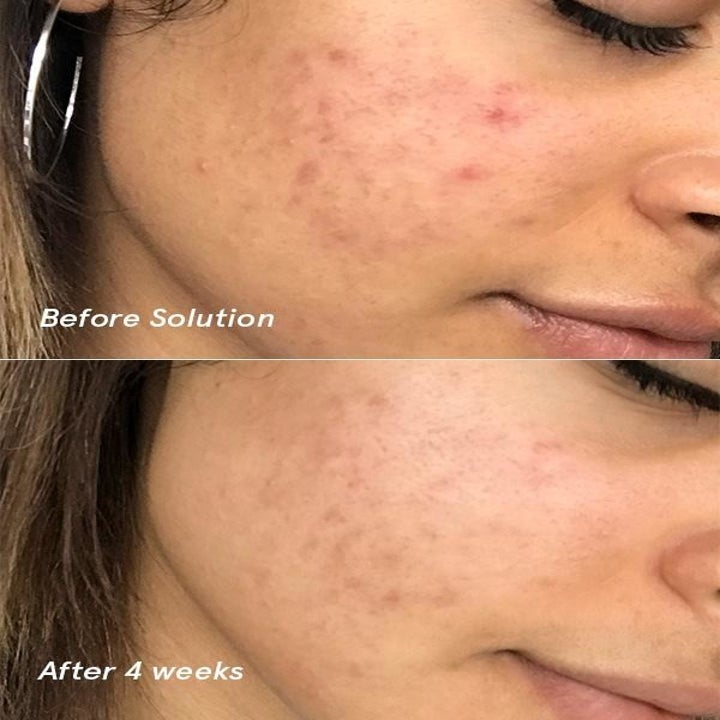 On the left, a model's face with breakouts before using the solution. On the right, a model's face with less breakouts after using the solution for four weeks