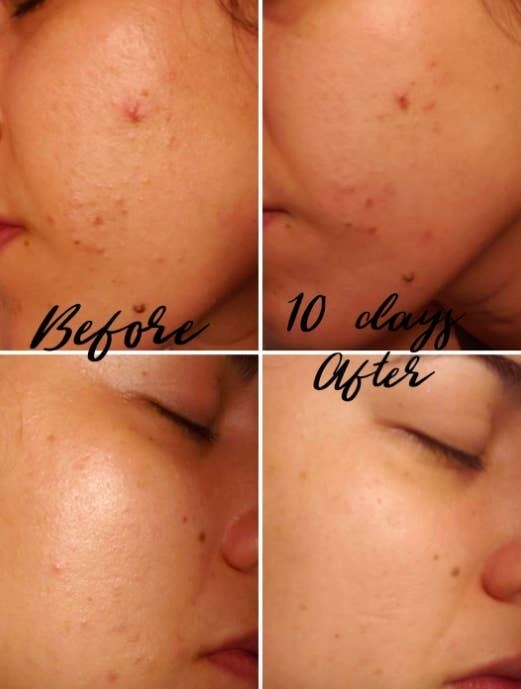 A series of photos showing a reviewer&#x27;s face of acne clearing up from using the cream