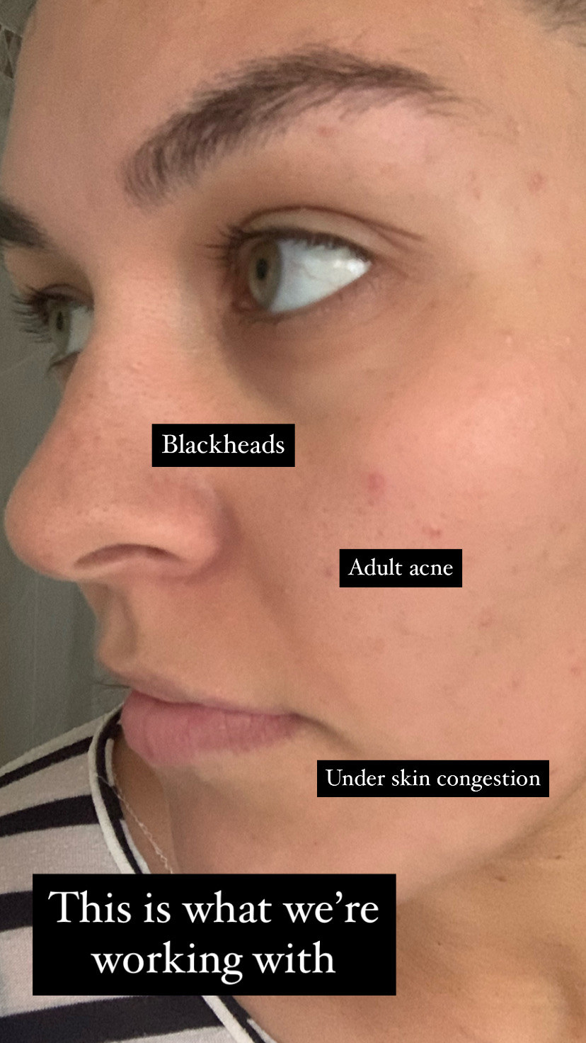 Close up of writer&#x27;s face highlighting main areas of skin problems