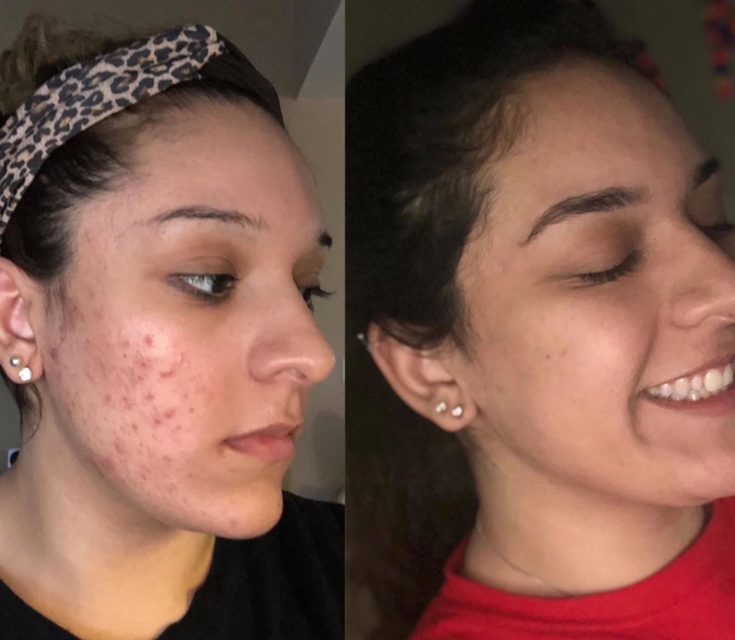 On the left, reviewer&#x27;s acne-covered cheek. On the right, reviewer&#x27;s clear, blemish-free skin