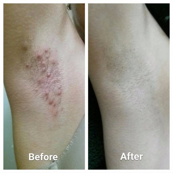 Reviewer&#x27;s inflamed armpit area with ingrown bumps in first photo, reviewer&#x27;s cleared up armpit skin after using the solution in second photo