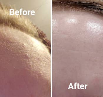 reviewer before and after photo of fine line and pimple on left and visibly less fine lines and pimples on right