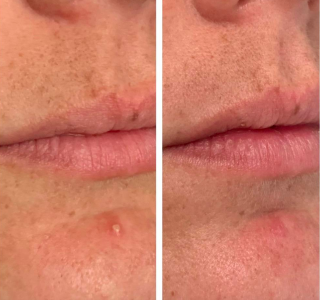 reviewer before-and-after photo showing zit 
