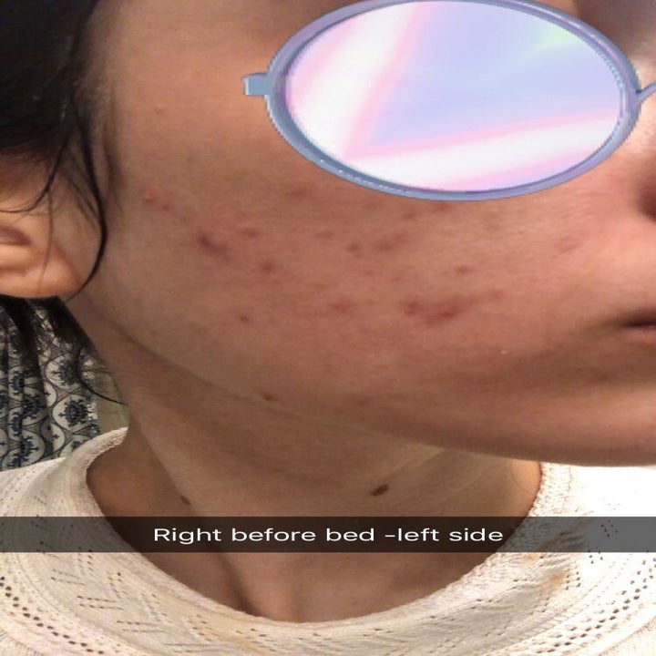 Reviewer's cheek with acne spots before applying Ebanel's Acne Spot Treatment Drying Lotion 