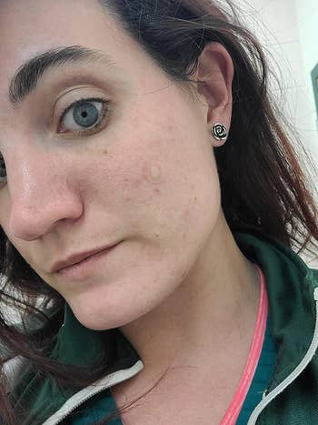 Clear Mighty Patch covers pimple on reviewer's cheek