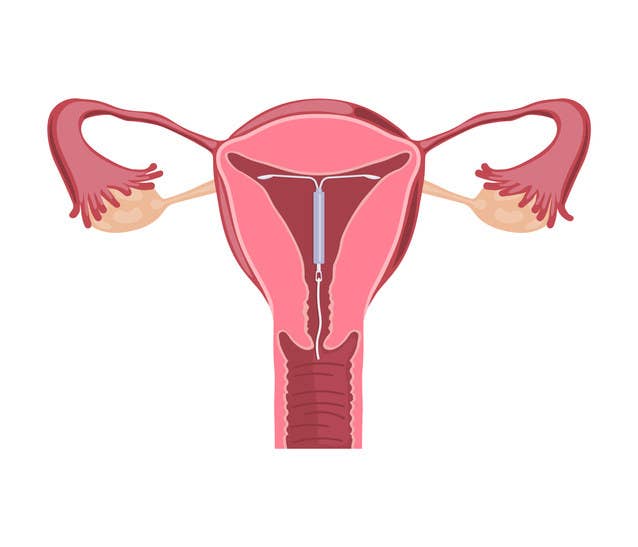 Stock image drawing of an IUD inside a uterus.