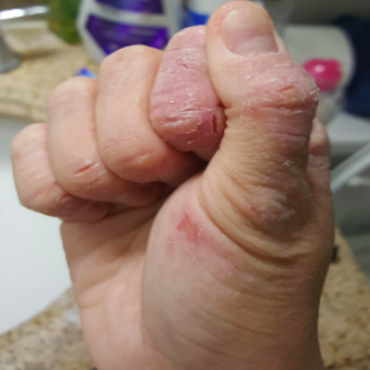 Severely cracked, dry hands from eczema 