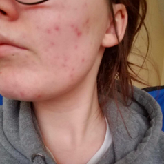 Same reviewer's face with acne no longer irritated and far less on face 