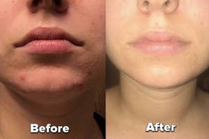 a side by side of a reviewer's skin before and after using a skincare product