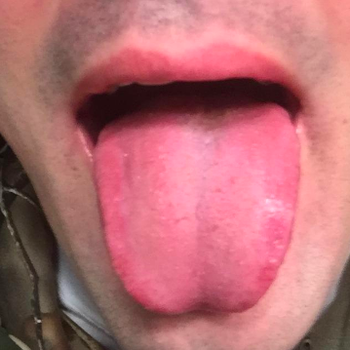 Clean tongue after use 