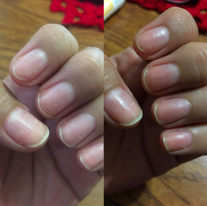 Reviewer&#x27;s nails after three days of use, less scratched and stronger 