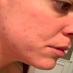 Same person with acne almost completely gone after using product 